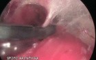 Cruroscopy - Ligation Of Incompetent Perforators
