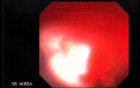 Upper Gastrointestinal Tract - Bleeding (2 of 7)