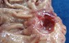 Diffuse Adenocarcinoma with signet ring cells (8 of 18)