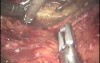 Robotic Abdominoperineal Resection with Distal Sacrectomy