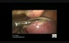Myomectomy