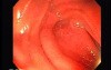 Hereditary Hemorrhagic Telangiectasia (Osler-Weber-Rendu syndrome) (1 of 7)