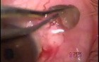 Limbal nodule excision with use of the Fugo Blade