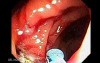 Giant Tubulo - Villous Adenoma (5 of 17)