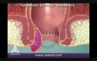 Thrombosed External Hemorrhoid - 3D Medical Animation