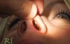 Rhinoplasty - Plastic Surgery Nose