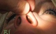 Rhinoplasty - Plastic Surgery Nose