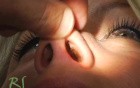 Rhinoplasty - Plastic Surgery Nose