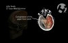 Growth of Subdural Hematoma with Mass Effect
