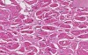 Heart - Amyloidosis
