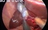 Anatomy of gallbladder during SILS
