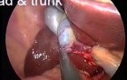 Anatomy of gallbladder during SILS