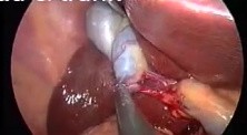 Anatomy of gallbladder during SILS