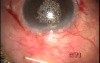 Fugo blade in cyst management