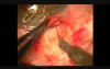 Insertion and fixation technique of Kumar's stainless steel glaucoma device