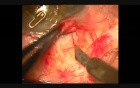 Insertion and fixation technique of Kumar's stainless steel glaucoma device