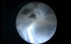 Arachnoid Endoventricular Cyst - Endoscopic Fenestration