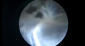 Arachnoid Endoventricular Cyst - Endoscopic Fenestration