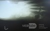Diabetic foot ulcer - neuropathic -associated with ostemyelitis 