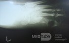 Diabetic foot ulcer - neuropathic -associated with ostemyelitis 