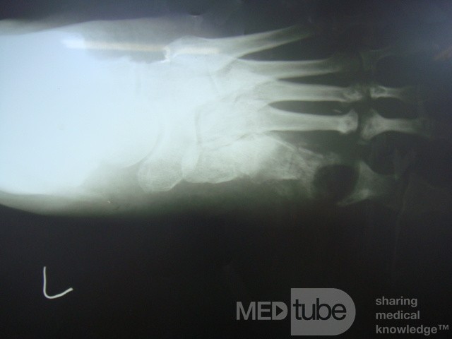 Diabetic foot ulcer - neuropathic -associated with ostemyelitis 
