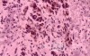 Gastrointestinal Stromal Tumour of the Rectum (5 of 5)