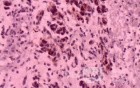 Gastrointestinal Stromal Tumour of the Rectum (5 of 5)
