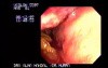 Endoscopy Of Rectal Adenocarcinoma (4 of 4)