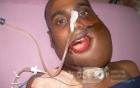 Lip Cancer  After Surgery