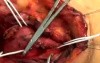 Carotid Body tumor