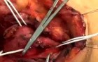 Carotid Body tumor