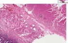 Barrett esophagus - Histopathology - Esophagus