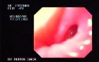 Esophageal Achalasia (2 of 7)