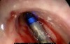 Frontal Balloon Sinuplasty