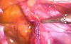 Inguinal hernia repair - TAPP method