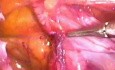 Inguinal hernia repair - TAPP method
