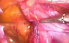 Inguinal hernia repair - TAPP method