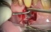 Reparation After An Atypical infection