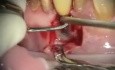 Reparation After An Atypical infection