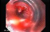 Esophageal Varix - Banding of Bleeding Varix