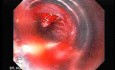 Esophageal Varix - Banding of Bleeding Varix