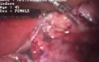Laparoscopic salpingectomy - female