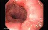 Synchronous Cancer (Gastric and Esophageal) - Assessment of the Lower Third of the Esophagus 