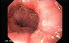 Synchronous Cancer (Gastric and Esophageal) - Assessment of the Lower Third of the Esophagus 