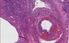 Polycystic ovarian disease