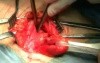 Inguinal hernia repair 