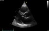Real-Time Three Dimensional Echocardiography - Parasternal Long Axis View on Mitral Valve, Video nr 3