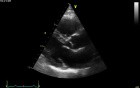 Real-Time Three Dimensional Echocardiography - Parasternal Long Axis View on Mitral Valve, Video nr 3