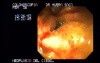 Colonoscopy - Adenocarcinoma Of The Cecum (2 of 4)