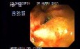 Colonoscopy - Adenocarcinoma Of The Cecum (2 of 4)